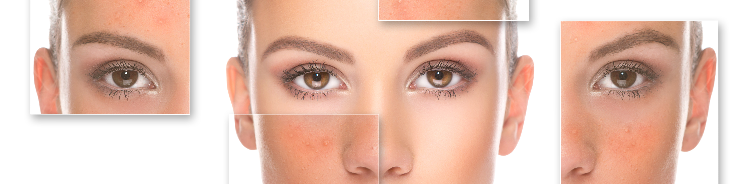 Rosacea Management in Brooklyn, NYC