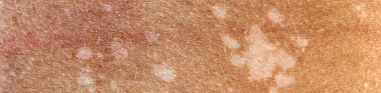 Skin Discoloration Management in Brooklyn, NYC